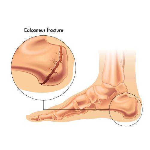 Stress Fracture In The Runner Therapy Glendale AZ