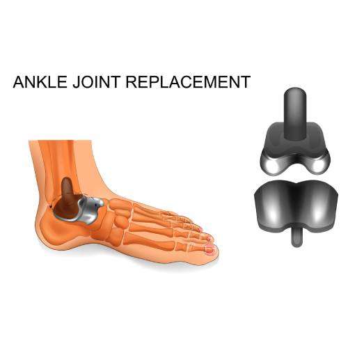 Total Ankle Replacement Glendale AZ
