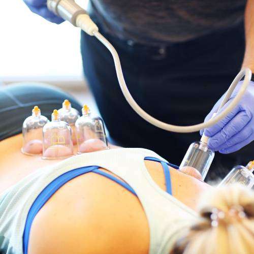Cupping Therapy Glendale AZ