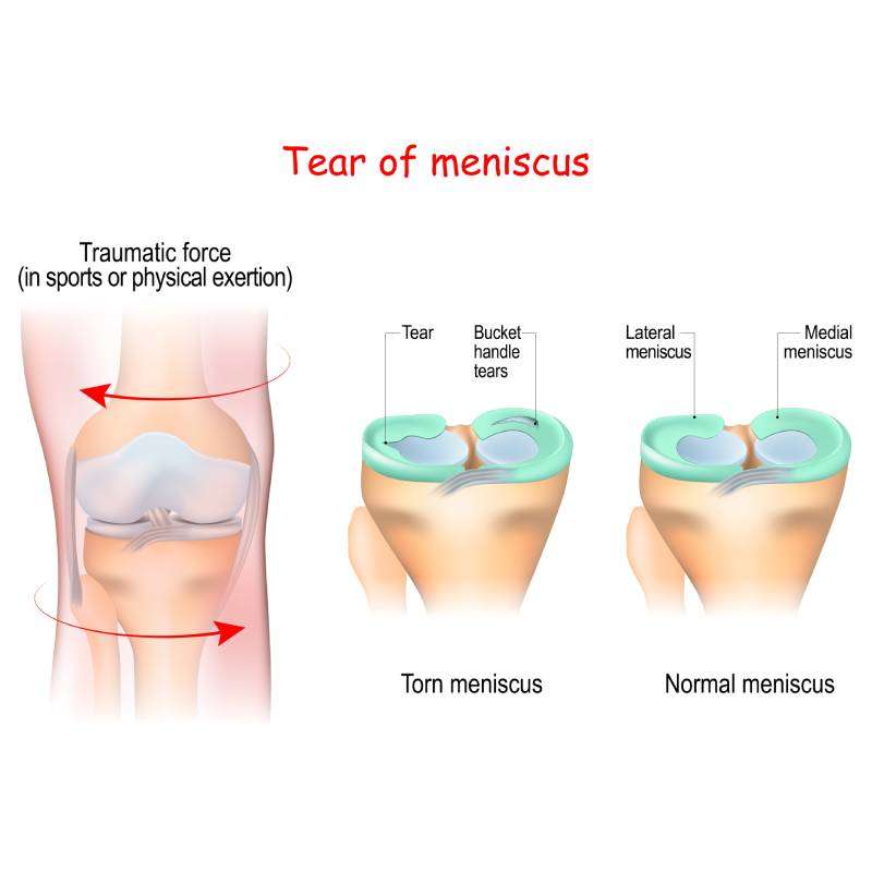 Meniscus Tear Therapy Glendale AZ