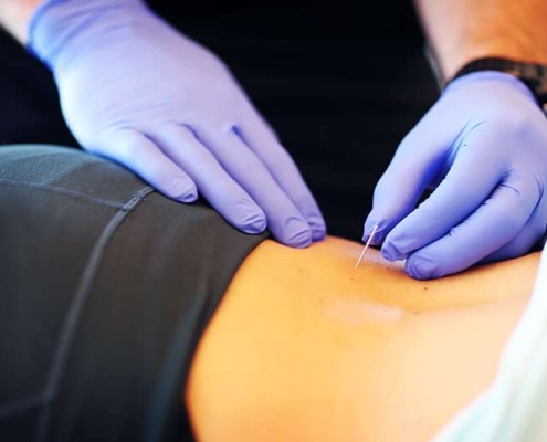 Dry Needling
