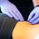 Dry Needling