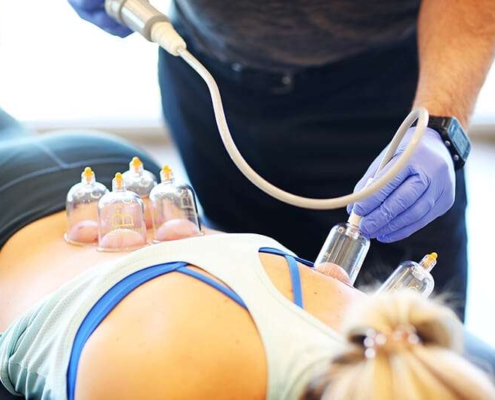 Therapeutic Cupping